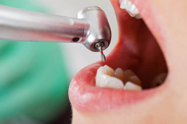 Best Emergency Dental Care for Broken or Chipped Teeth in Burns, TN